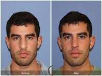 Orange-County-Newport-Beach-Male-Rhinoplasty-63-F (1).jpg