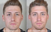 Male-Rhinoplasty-Set-4-1.jpg