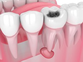 3d-render-of-jaw-with-tooth-cavity-and-cyst-or-dental-pulp-1024x768.jpg