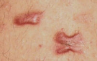 keloid-pic-02.jpg