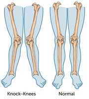 knockknees2.jpg