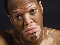 Vitiligo dharmesh 22 728