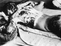 790px Victim of Atomic Bomb 002