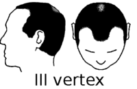 Partial Norwood scale for male pattern baldness