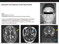 masseter hypertrophy.png