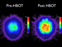 Pre HBOT _ Post HBOT.gif