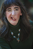 Woman with disfigured face 252086