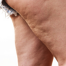 Cellulite