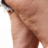 Cellulite